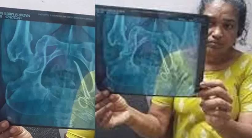 scissors found in stomach x ray report