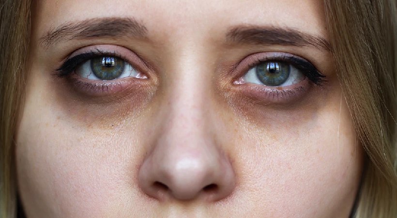 dark-circles-not-just-lack-of-sleep
