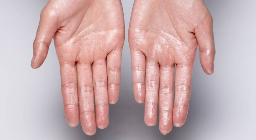 hyperhidrosis