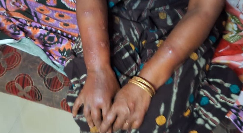 sunstroke-reported-in-thiruvalla-nedumpram-woman-suffers-burn-injuries