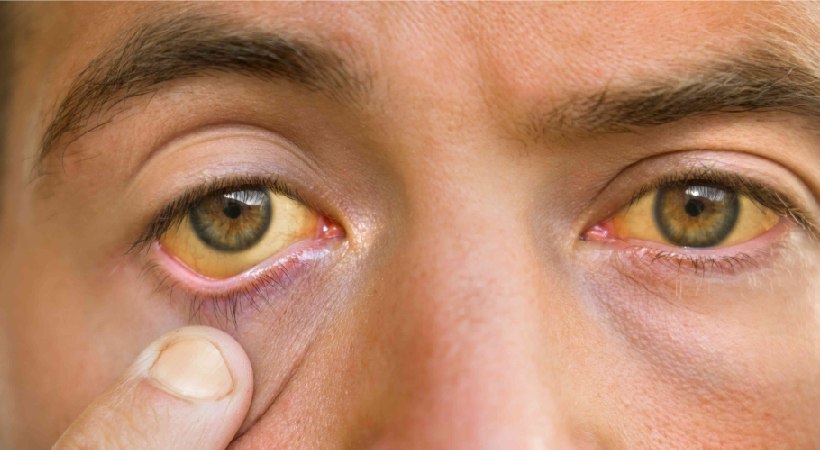 Jaundice Risk Rises in Summer