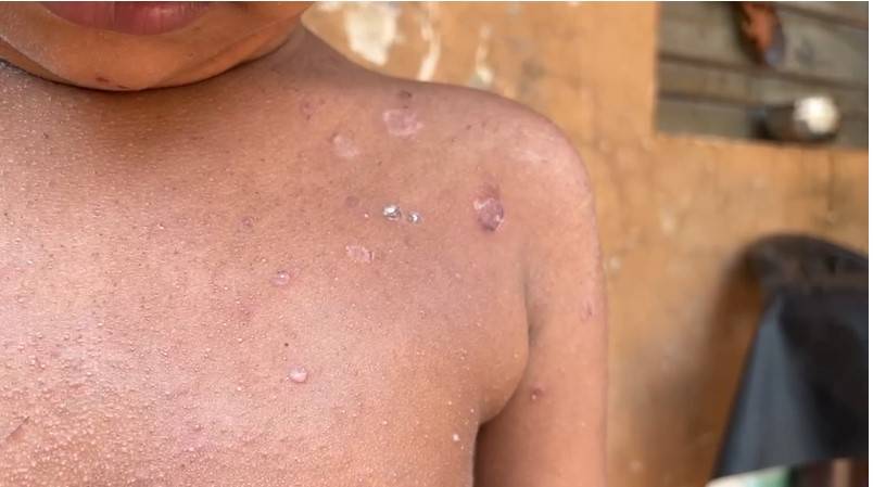 മലപ്പുറത്ത് മുറ്റത്ത് കളിച്ചുക്കൊണ്ടിരുന്ന നാലു വയസുകാരിക്ക് സൂര്യതാപമേറ്റു